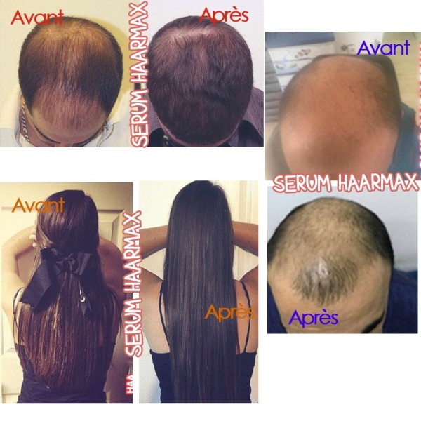 Hair Growth Serum and its Derma Roller - Haarmax Hair Growth Serum and its Derma Roller - Haarmax