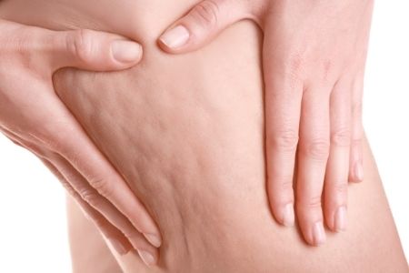 Cellulite sur une jambe