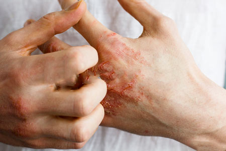 Eczema